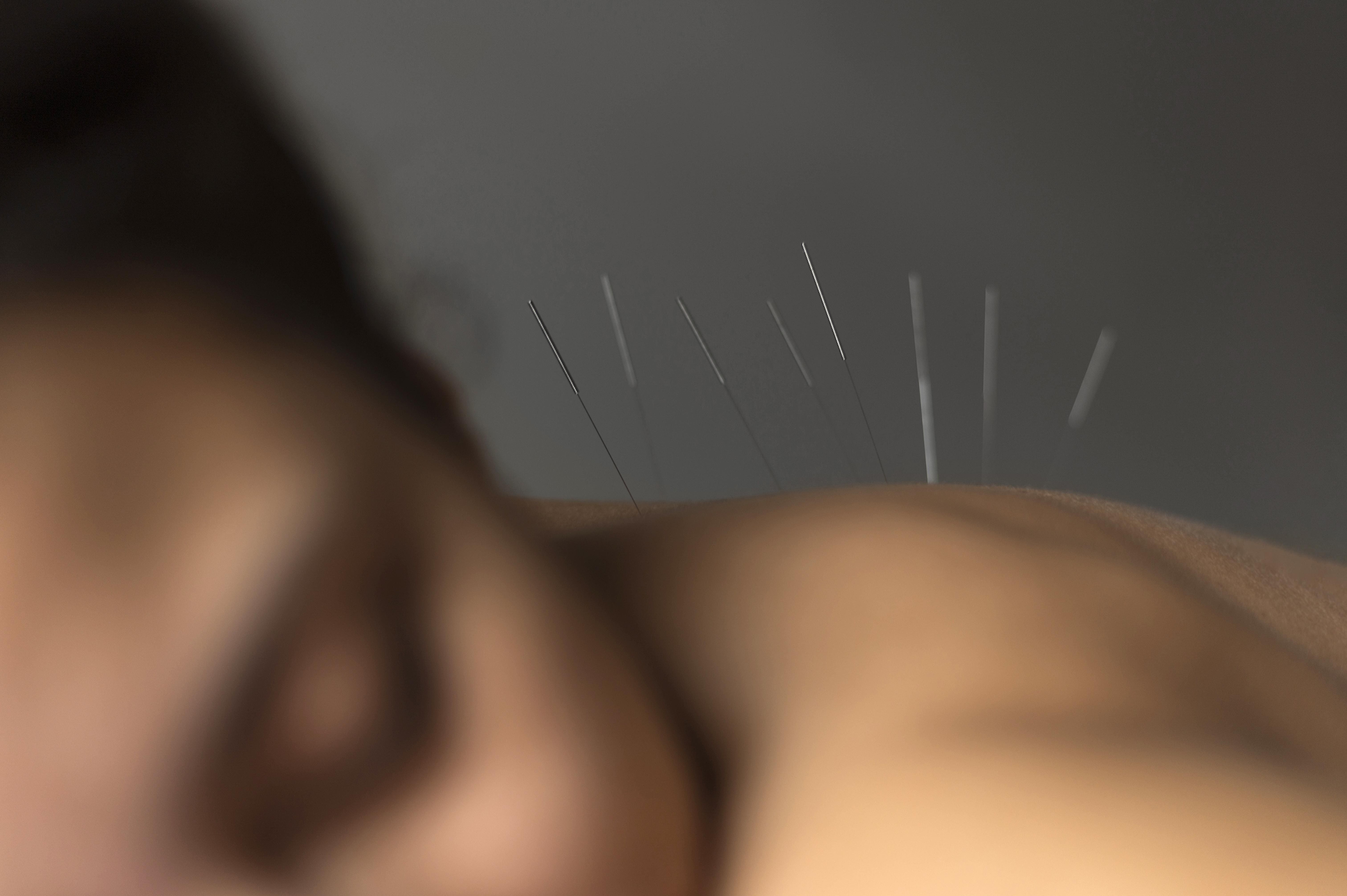 Dry needling